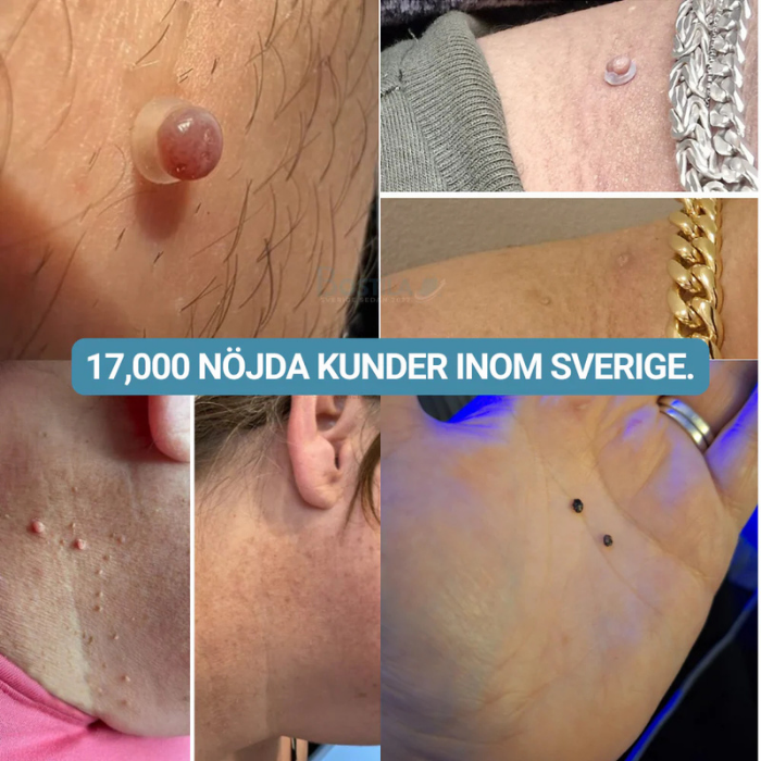 NORDIKE™ - Premiumset mot hudflikar – Synliga resultat utan smärta