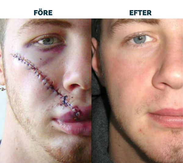 Avancerad ärrspray för alla typer av ärr ⚡️