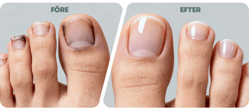 SmidigNagel™ | Säker Nagelvård