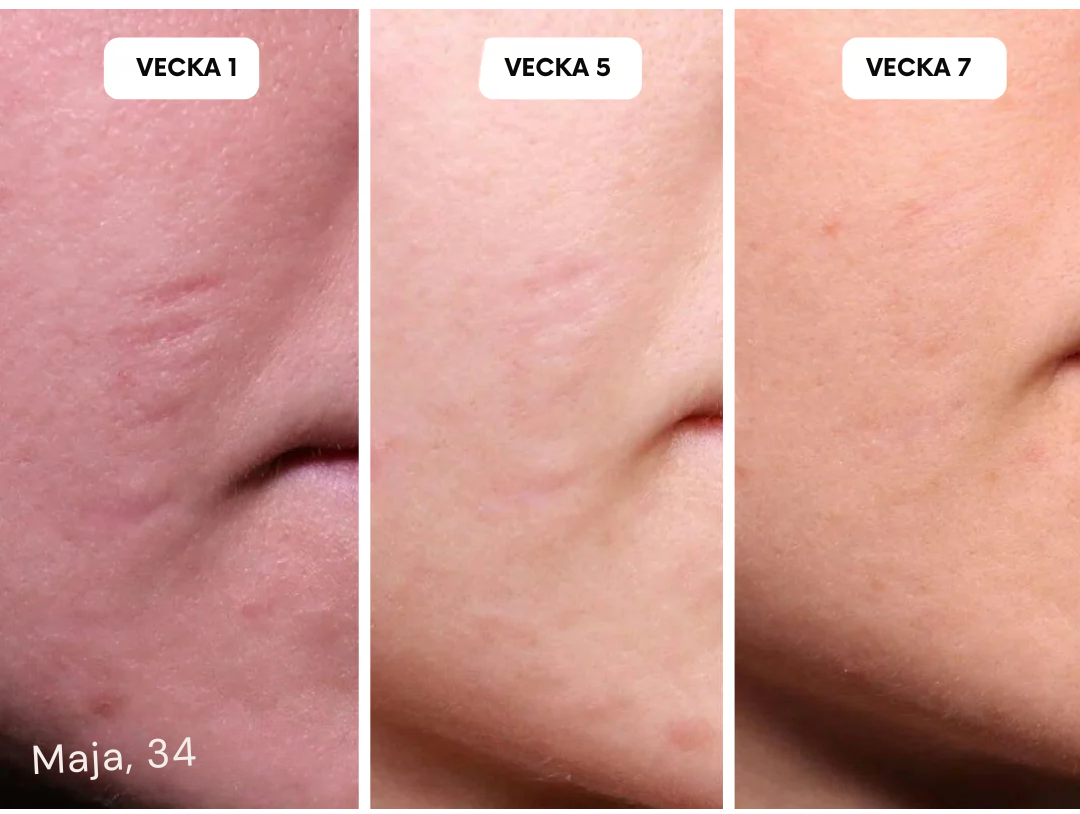 HudLäk | Ärrlösningar