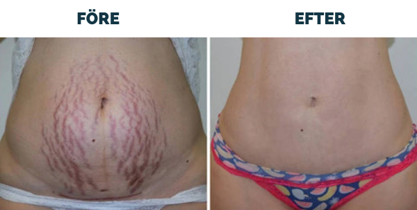 Avancerad ärrspray för alla typer av ärr ⚡️