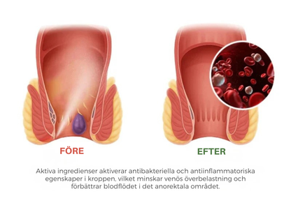 HemoFix | Snabbverkande örtbaserad spray för lindring av hemorrojder
