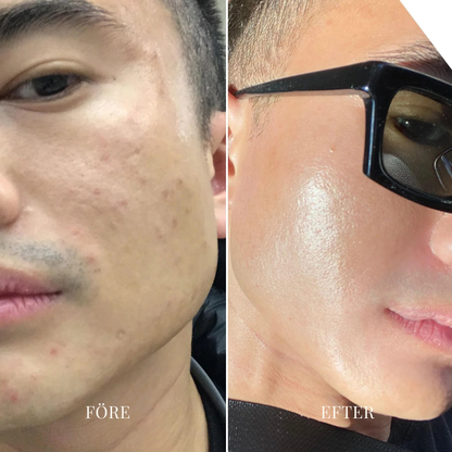 PoreFritt™ | Hudvakuum för borttagning av pormaskar