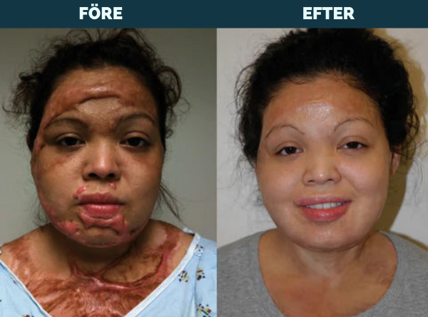 Avancerad ärrspray för alla typer av ärr ⚡️