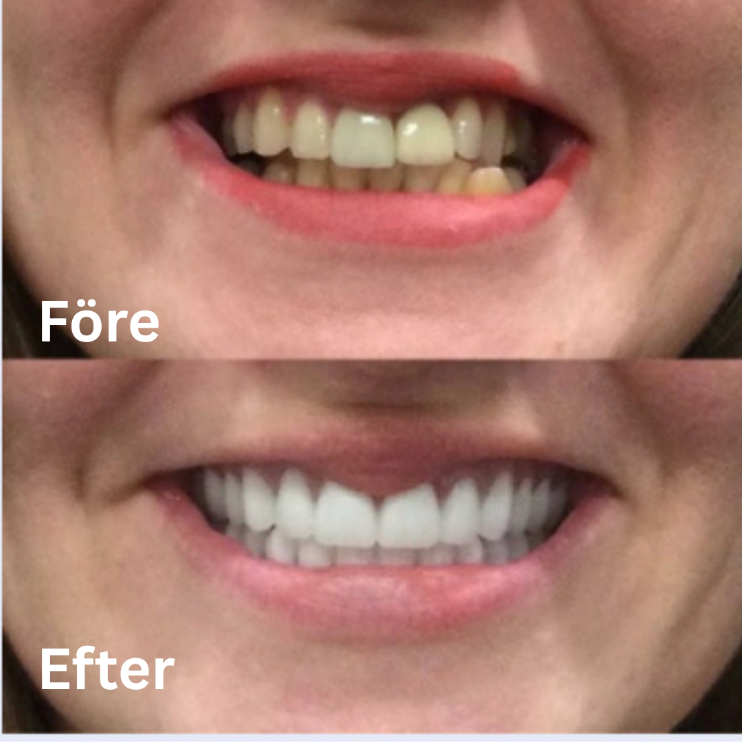 ProtesHåll Ultra | DentHold-lim