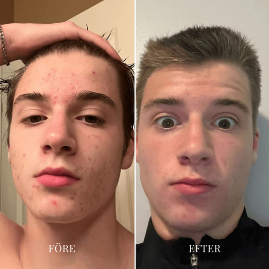 PoreFritt™ | Hudvakuum för borttagning av pormaskar