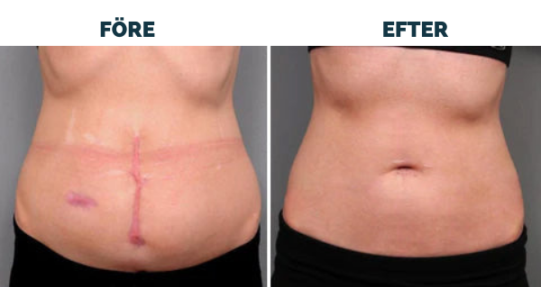 Avancerad ärrspray för alla typer av ärr ⚡️