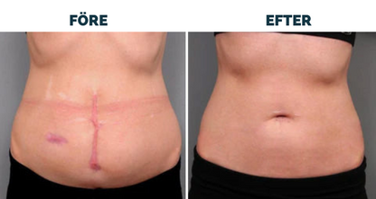 Avancerad ärrspray för alla typer av ärr ⚡️