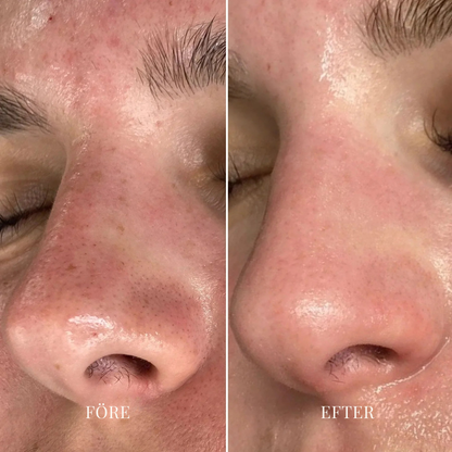 PoreFritt™ | Hudvakuum för borttagning av pormaskar