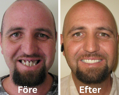 ProtesHåll Ultra | DentHold-lim