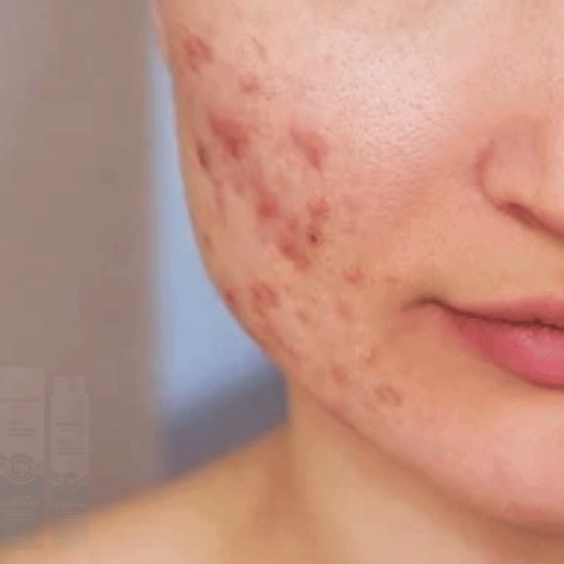 Avancerad ärrspray för alla typer av ärr ⚡️